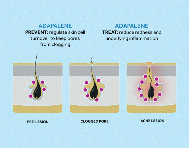 Differin Adapalene Gel 0.1% Acne Treatment